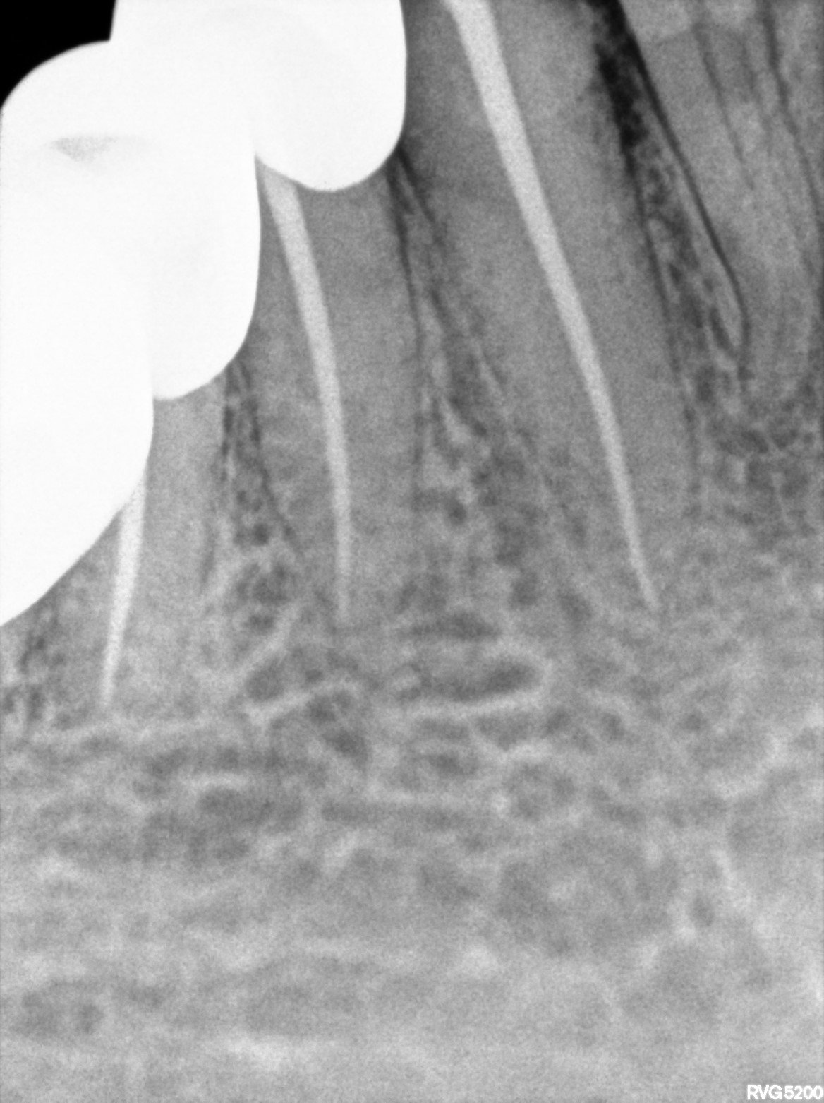 Dental X-ray